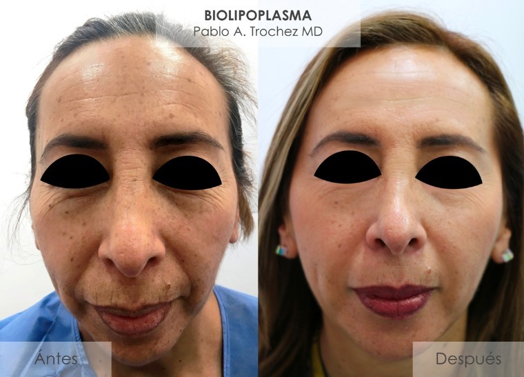 Doctor Pablo Trochez creador del Biolipoplasma explica sus ventajas y usos